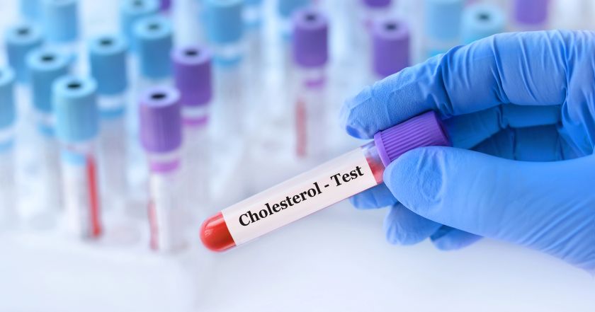 Doktor drží zkumavku se vzorkem krve s Cholesterol testem na pozadí lékařské zkumavky s analýzami. Masticha Chios cholesterol a trávení